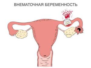 4 главных признака внематочной беременности и экстренные действия