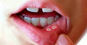 Стоматит на губе у ребенка