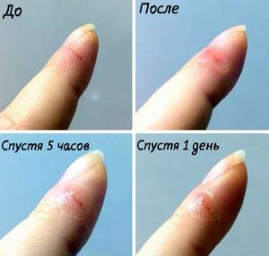 Как вылечить трещины на пальцах рук медицинский клей БФ-6
