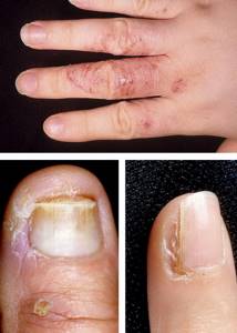 7 главных причин и 12 лучших методов лечения трещин на пальцах рук