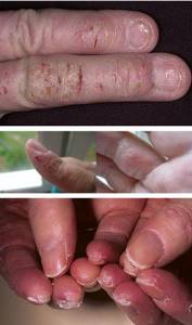 7 главных причин и 12 лучших методов лечения трещин на пальцах рук