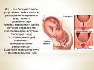 Тонус матки при беременности на ранних сроках. Причины, симптомы, лечение, как распознать и что делать