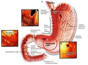 Афтозные папулы антрального отдела желудка: причины и лечения