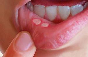 Воспалении слизистой оболочки полости рта