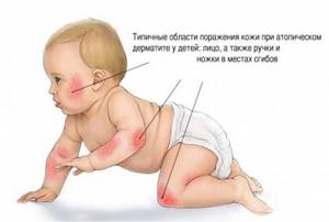 Типичные области поражения дерматитом у детей