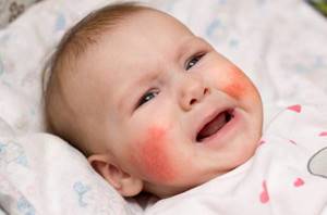 Первая стадия аллергического дерматита у детей фото