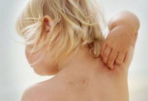 Аллергический дерматит у детей: причины и признаки