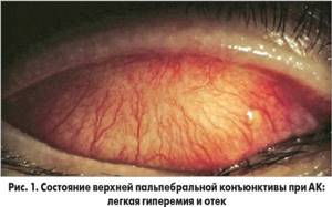 Воспаленная конъюнктива глаза