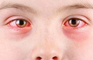 Аллергический конъюнктивит, симптомы и лечение у взрослых и детей