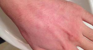 Холодовая аллергия на руках
