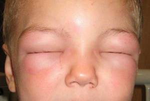Аллергия на холод: симптомы и лечение у взрослых и детей