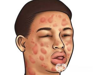 Как и другие аллергические реакции, холодовая аллергия может вызвать анафилактический шок