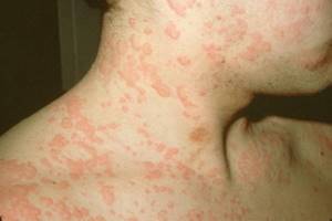 Аллергия на холод: симптомы и лечение у взрослых и детей