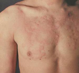 Аллергия на лекарства: фото, симптомы, что делать, лечение