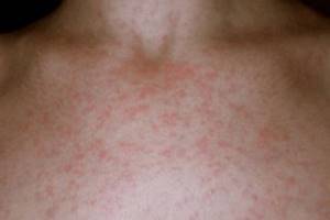 Аллергия на солнце: симптомы и лечение в домашних условиях