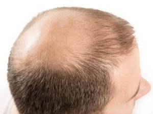 Алопеция — выпадение волос у женщин, симптомы, причины и лечение