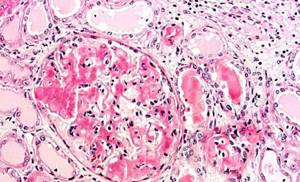 Амилоидоз почек или патологическое скопление амилоида в тканях органа