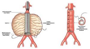 Аневризма аорты брюшной полости: симптомы и причины, диагностика, лечение и прогноз жизни