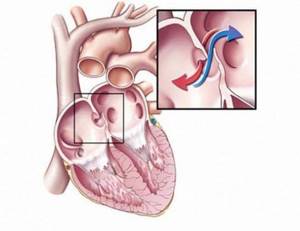 Аневризма аорты брюшной полости: симптомы и причины, диагностика, лечение и прогноз жизни