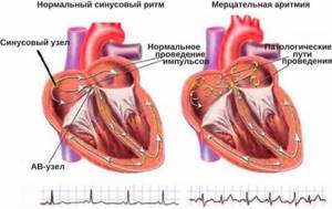 Аритмия сердца. Чем опасна, причины, симптомы, как лечить в домашних условиях