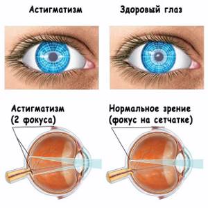 Астигматизм глаз у взрослых