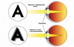 астигматизм глаз