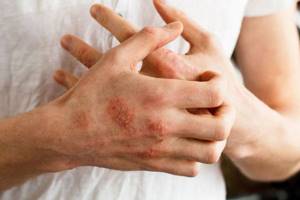 Сыпь и зуд при атопическом дерматите