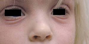 Атопический дерматит: симптомы и лечение у взрослых и детей