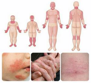 Атопический дерматит: симптомы и лечение у взрослых и детей
