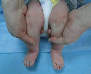 Атрофия ног у новорожденного