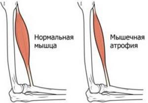 Атрофия мышц: ног, рук, лечение, симптомы и восстановление атрофированных мышц