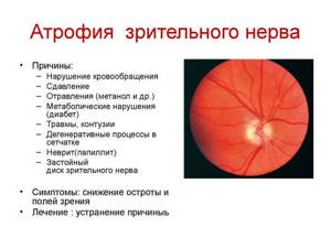 В каких странах и как лечат атрофию зрительного нерва?
