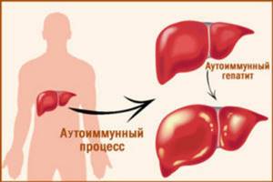Аутоиммунный гепатит: симптомы