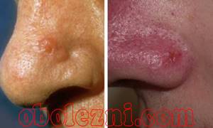 Фотографии с признаками начальной стадии базалиомы на носу
