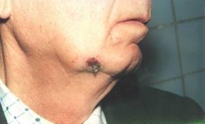 Базалиома — фото кожи, начальная стадия, опасные признаки, лечение и удаление