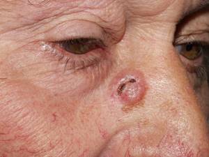 Базалиома — фото кожи, начальная стадия, опасные признаки, лечение и удаление