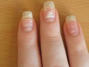 Белые пятна на ногтях причина, лечение, профилактика