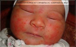 Применение Бепантена при аллергии на лице