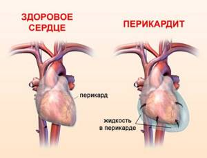 Боль под левой грудиной у женщин спереди при дыхании, движении, нажатии, после еды. Причины и что делать