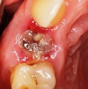 Осложнение после удаления зуба — воспалительный процесс