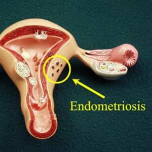 Эндометриоз на макете матки