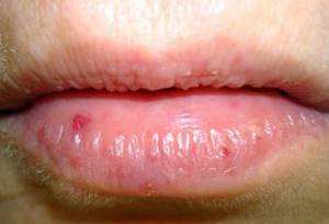 Точечные кровоизлияния на губах