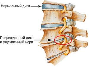 Боль в левом боку под ребрами спереди, сзади у женщин, в животе, ноющая боль при беременности, при нажатии
