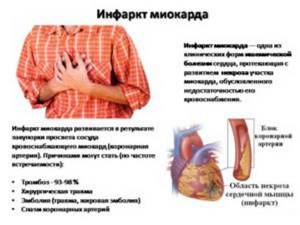 информация об инфаркте миокарда у человека