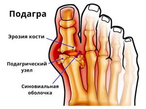 Боли в стопах ног. Причины и лечение при ходьбе, после вставания. Народные средства, мази