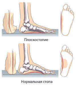 Боли в стопах ног. Причины и лечение при ходьбе, после вставания. Народные средства, мази