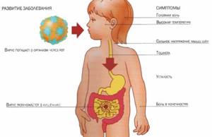 Ротавирусная кишечная инфекция у ребенка