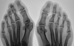 рентген суставов больших пальцев ног