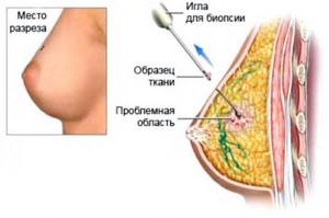 Чем лечить мастопатию у женщин после 30, 40, 50 лет. Мази, антибиотики, народные средства, таблетки, витамины