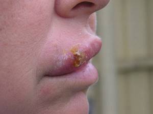 Чем лечить герпес на губах. Эффективные народные средства от герпеса